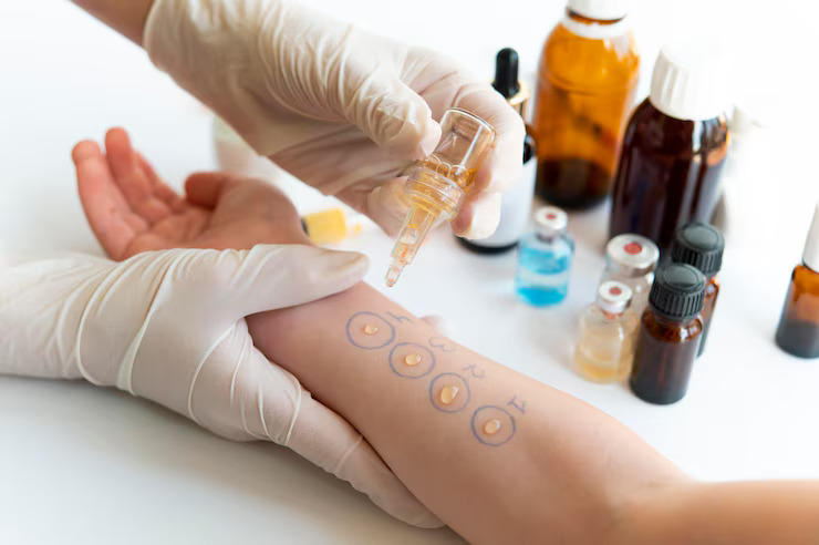 skin prick test