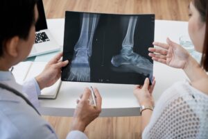 Bone Fracture Treatment